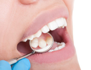 جلوگیری از پوسیدگی و خرابی دندان