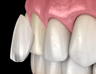 مزایای ونیر دندان