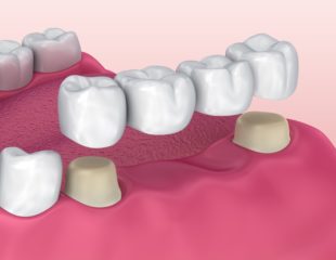 بریج دندان