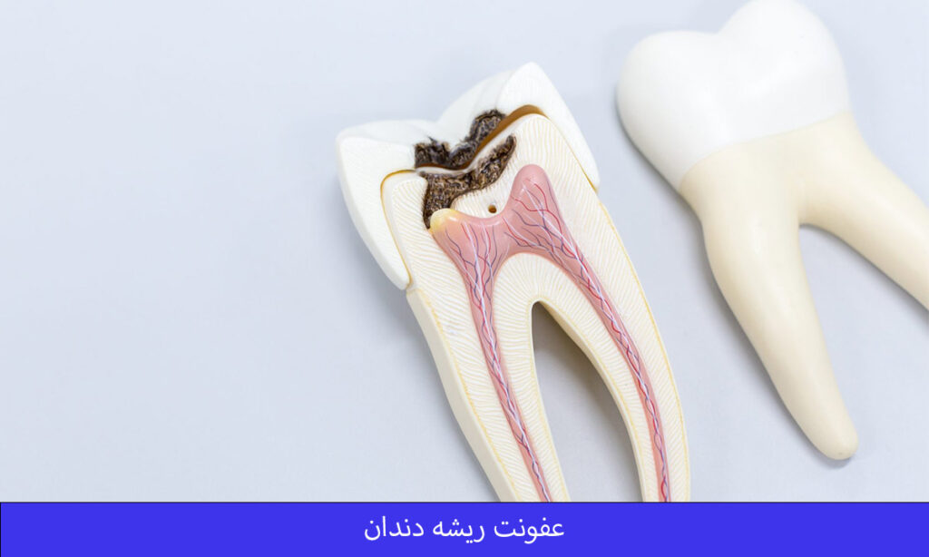 عفونت ریشه دندان