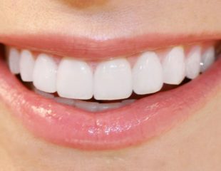 قیمت لمینت دندان در سال 99