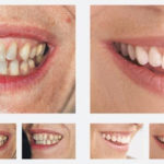 پک بلیچینگ دندان-1