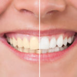 بلیچینگ دندان با بیمه-1