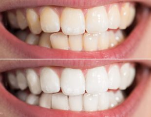 بلیچینگ دندان بهتر است یا کامپوزیت-1