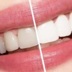 بلیچینگ دندان بعد از ارتودنسی-1