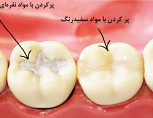 ترمیم دندان پوسیده-1