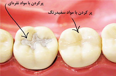 ترمیم دندان پوسیده-1