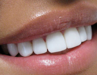 ترمیم و زیبایی دندان جلو