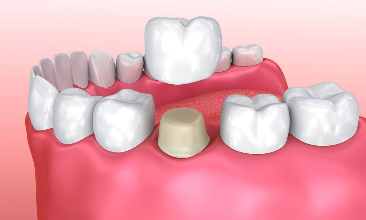 پروتز ثابت روکش دندان