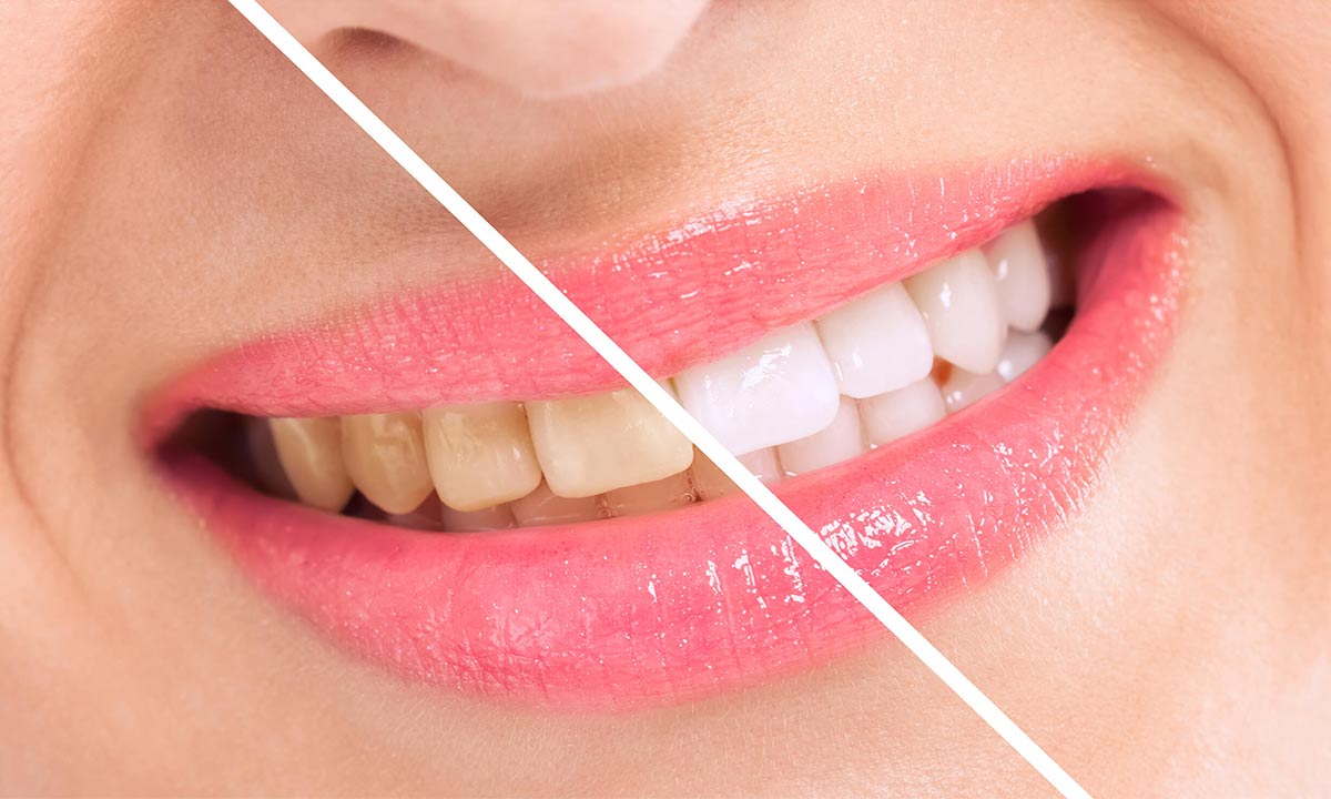 قبل و بعد از بلیچینگ دندان
