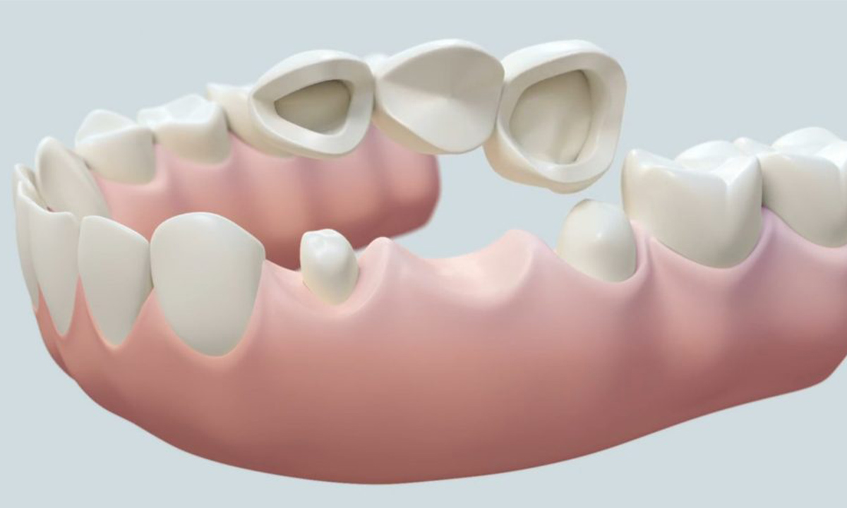 مراحل پل دندان