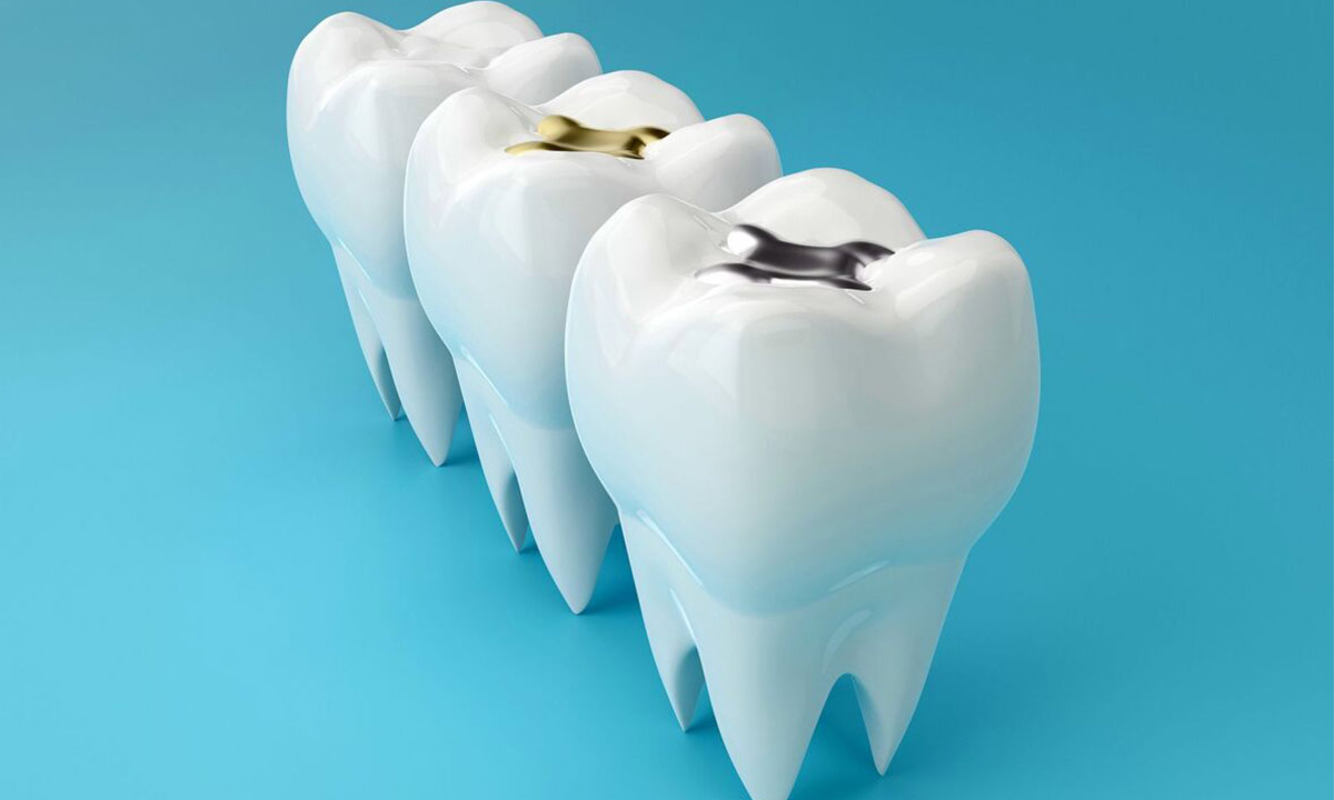 موارد مورد استفاده برای پر کردن دندانها از جمله آمالگام