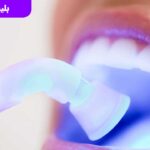 بلیچینگ دندان یکی از راه های سفید کردن دندان