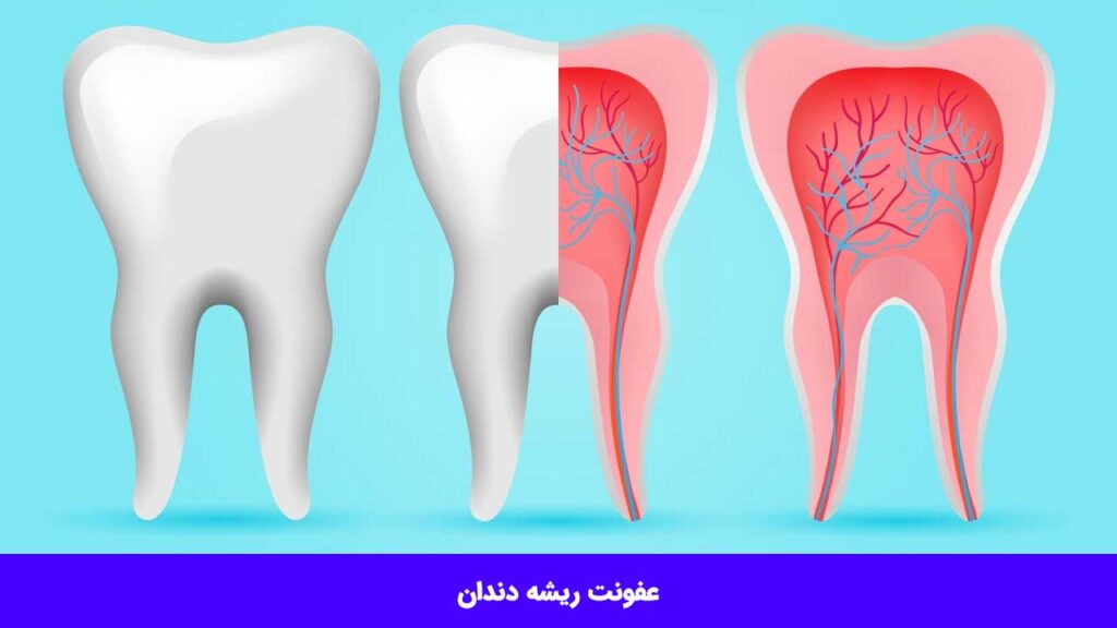عفونت ریشه دندان