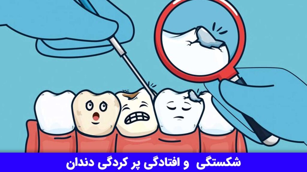 شکستگی و افتادگی پر کردگی دندان