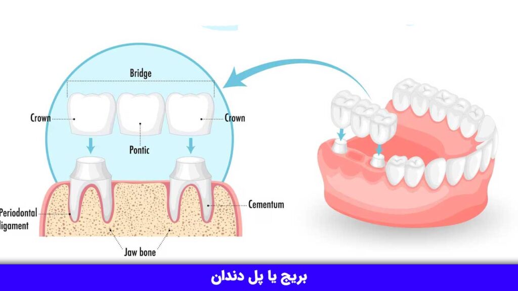 بریج یا پل دندان