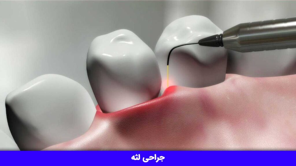جراحی لثه