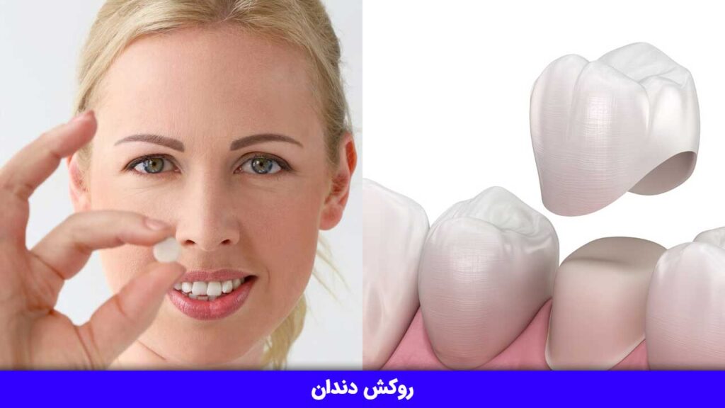 روکش دندان