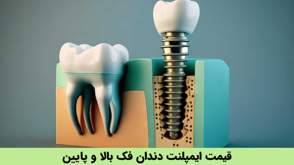 قیمت ایمپلنت دندان فک بالا و پایین