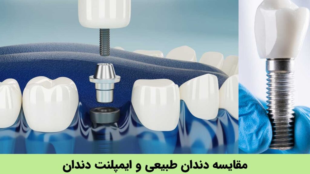 مقایسه دندان طبیعی و ایمپلنت دندان